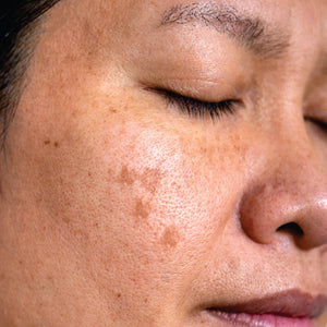 Close-up of a person's face with visible skin texture and pores.